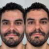 Relleno de Ojeras - Imagen 2