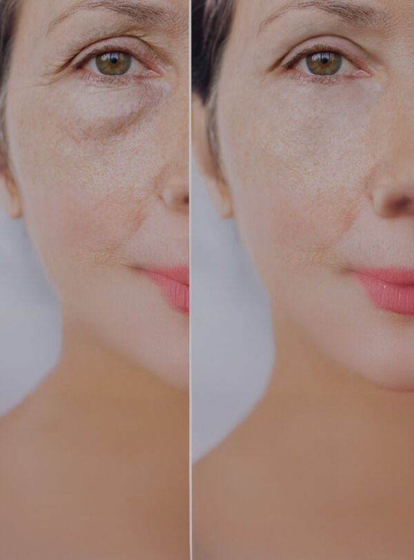 ADN de Salmón – Tratamiento para Ojeras