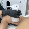 HIFU Liposonix en Brazos - Image 3
