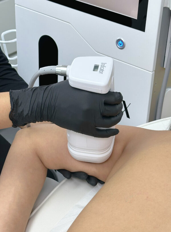 HIFU Liposonix en Brazos - Image 3