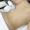 HIFU Liposonix en Flancos - Image 2