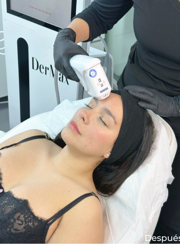 HIFU medio rostro - Imagen 2