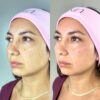 Atenuación de Surcos Nasogenianos - Imagen 2
