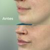 Perfilado y Aumento de Labios - Imagen 2