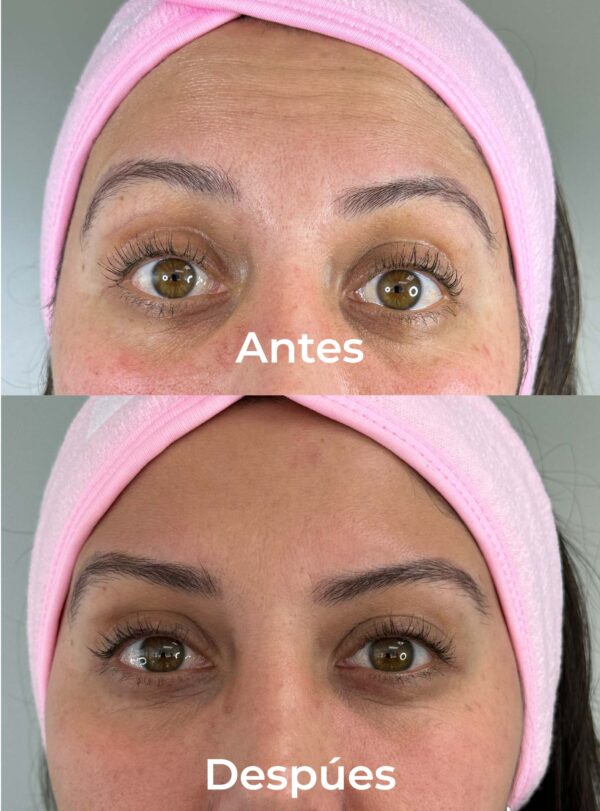 Botox 1 zona - Image 2