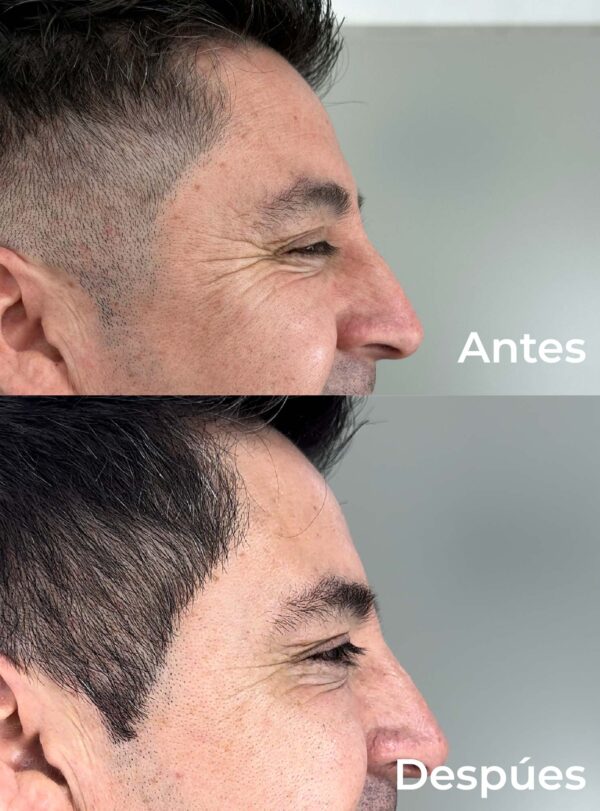 Botox 1 zona - Image 3