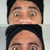 Botox 3 zonas + Pink Glow de regalo 🎁 - Imagen 7