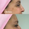 Botox 3 zonas + Pink Glow de regalo 🎁 - Imagen 6