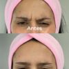 Botox 3 zonas + Pink Glow de regalo 🎁 - Imagen 3