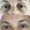 ADN de Salmón – Tratamiento para Ojeras - Imagen 2