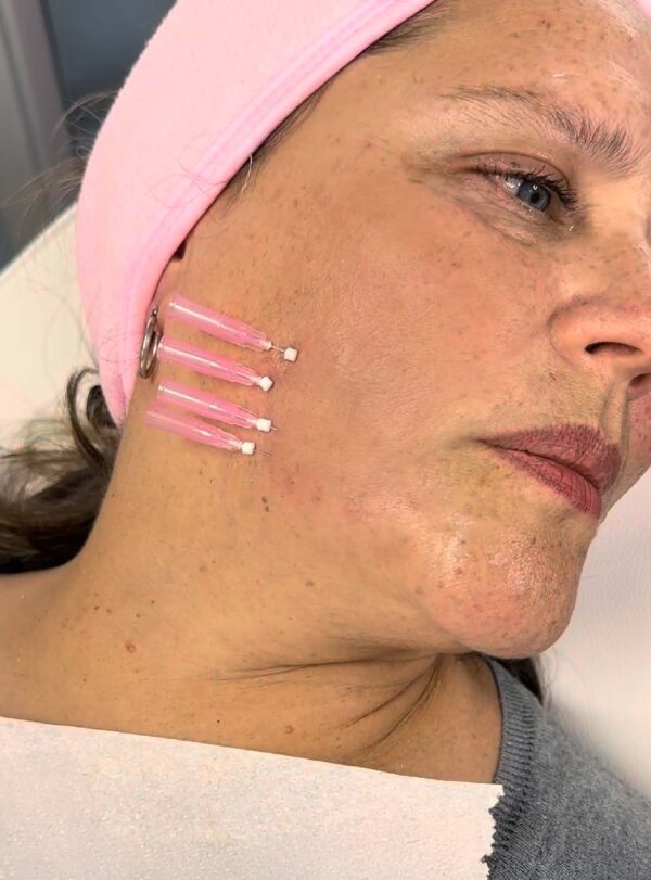 HILOS REVITALIZANTES FACIALES