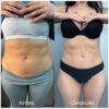 LIPOLAX ABDOMEN Y ESPALDA - Imagen 2
