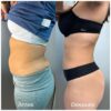LIPOLAX ABDOMEN Y ESPALDA - Imagen 3