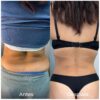 LIPOLAX ABDOMEN Y ESPALDA - Imagen 4