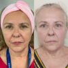 HILOS REVITALIZANTES FACIALES - Imagen 2