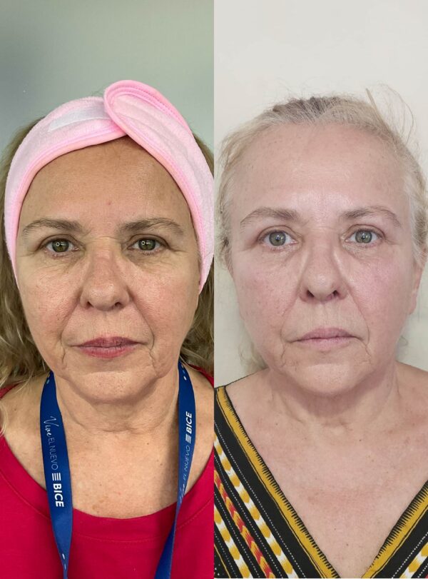 HILOS REVITALIZANTES FACIALES - Image 2