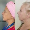 HILOS REVITALIZANTES FACIALES - Imagen 3
