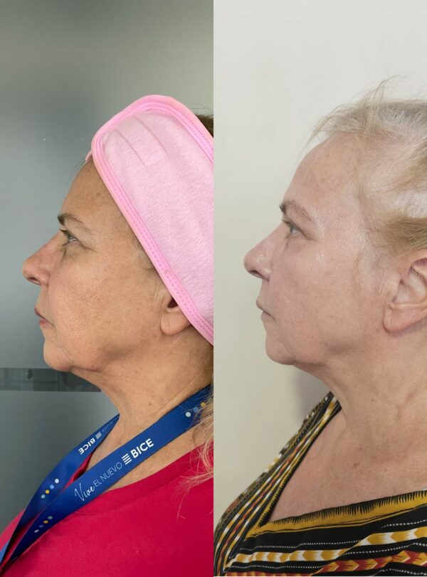 HILOS REVITALIZANTES FACIALES - Image 3