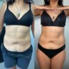 LIPOLAX ABDOMEN Y ESPALDA - Imagen 6