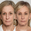 Rejuvenece tu rostro con SCULPTRA® - Imagen 3
