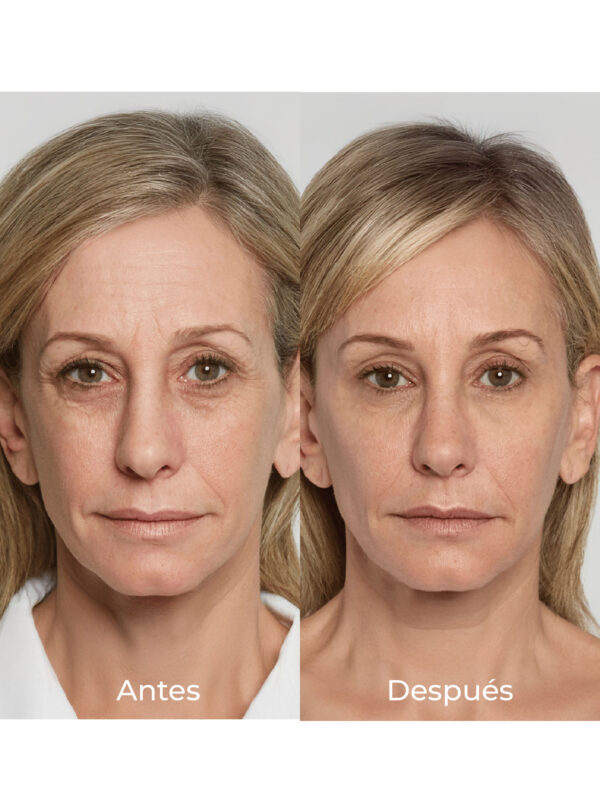 Rejuvenece tu rostro con SCULPTRA® - Image 3