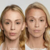 Rejuvenece tu rostro con SCULPTRA® - Imagen 2