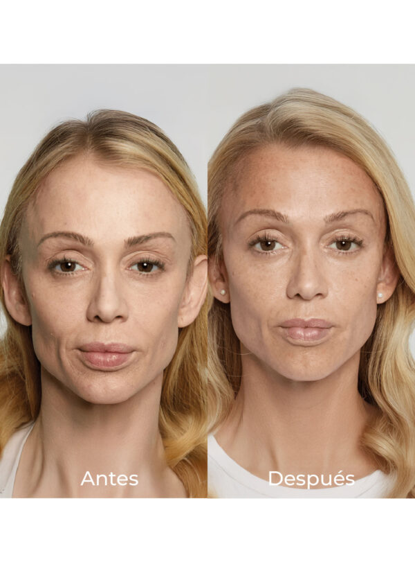 Rejuvenece tu rostro con SCULPTRA® - Image 2